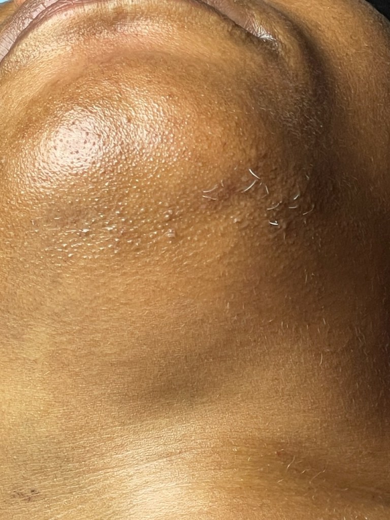 before-gray-chin-hair