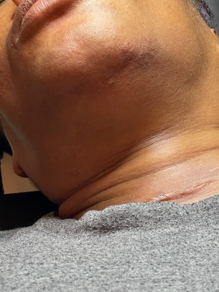 after-gray-chin-hair